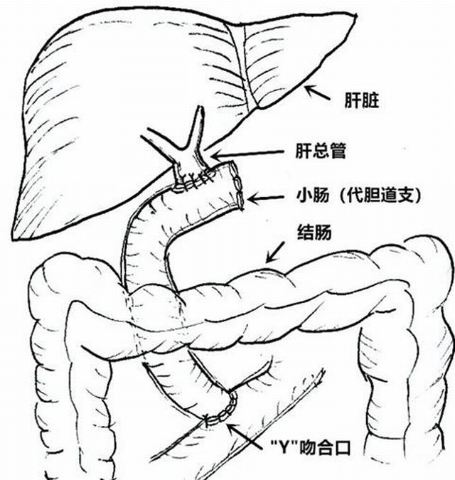 小切口治大病 经脐单孔腹腔镜微创治疗先天性胆总管囊肿